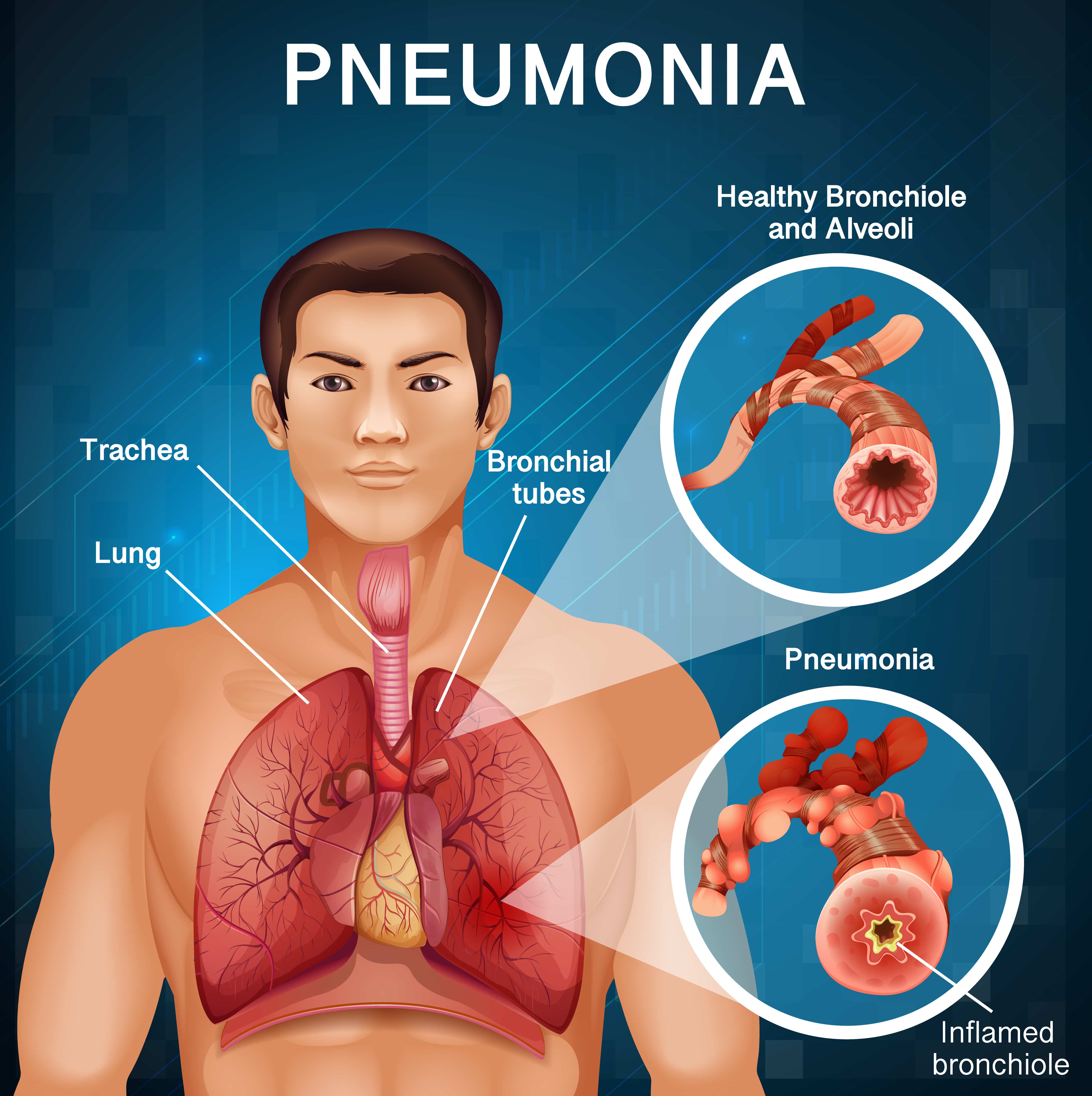 Respiratory and Chest Diseases: Causes, Symptoms, and Effective Treatment